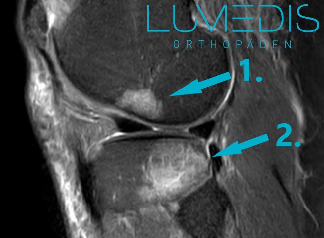 Bone bruise (Knochenschwellung / Ödem) nach einem vorderen Kreuzbandriss im MRT