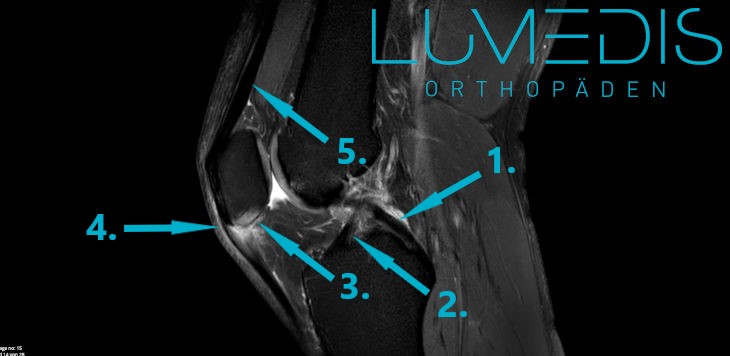 MRT einer Entzündung der Patellasehne MRT einer Entzündung der Patellasehne