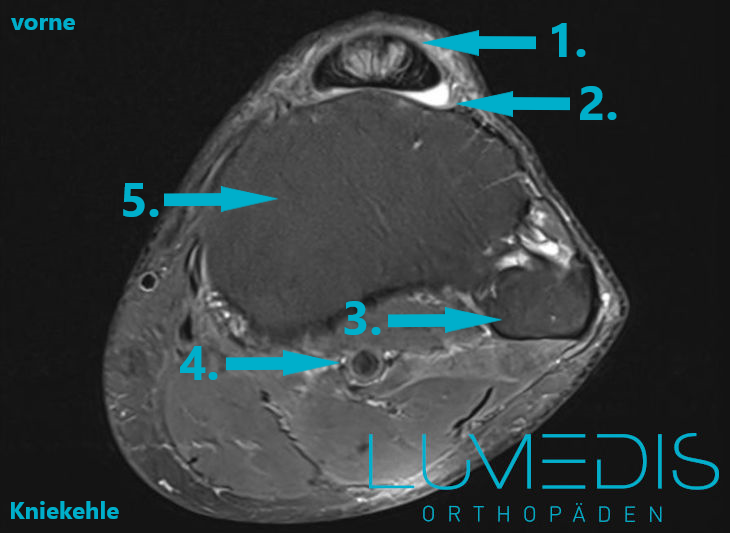 Entzündung der Patellasehne Entzündung der Patellasehne