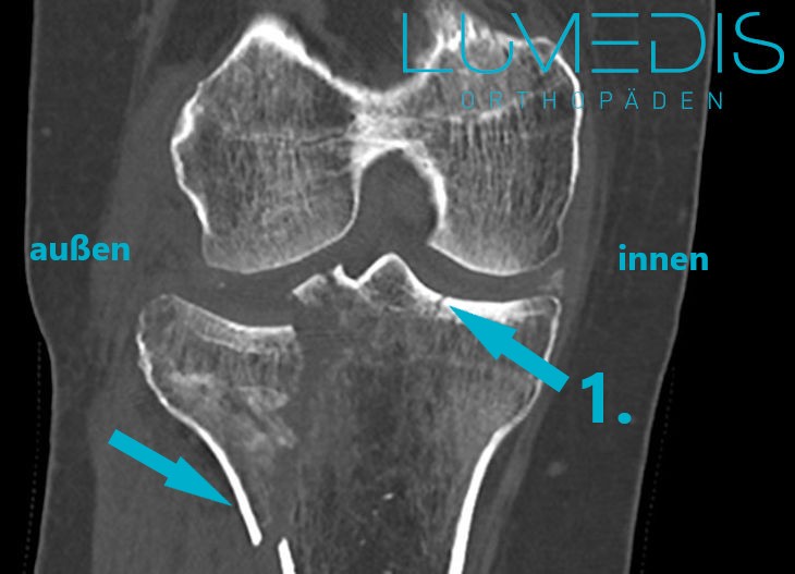 CT einer rechten lateralen Tibiakopffraktur CT einer rechten lateralen Tibiakopffraktur