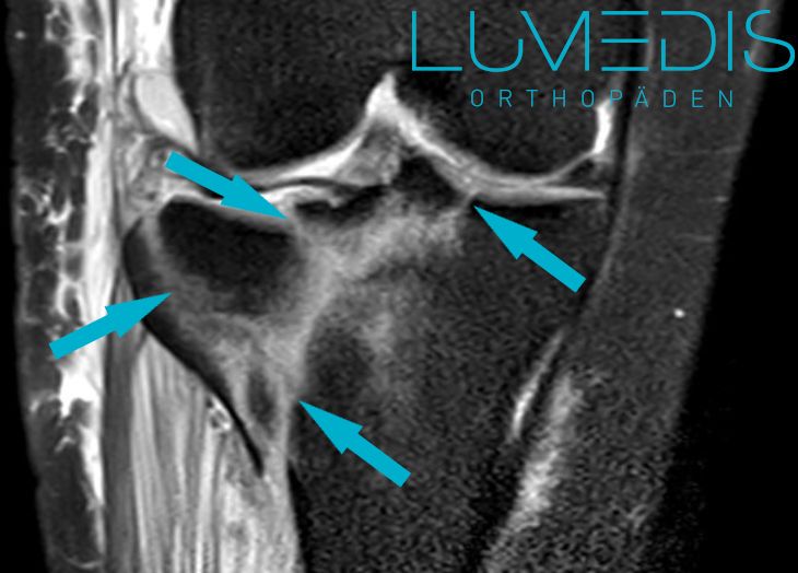 MRT einer rechten lateralen Tibiakopffraktur MRT einer rechten lateralen Tibiakopffraktur