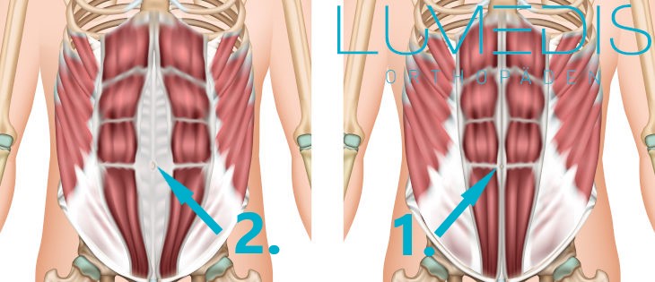 Abbildung einer Rectusdiastase