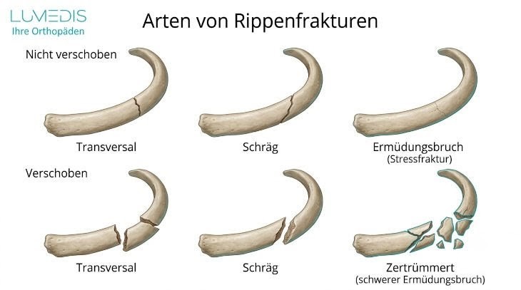 Arten von Rippenbrüchen Arten von Rippenbrüchen