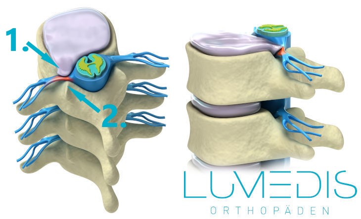 Bandscheibenvorfall mit Druck auf die Nervenwurzel