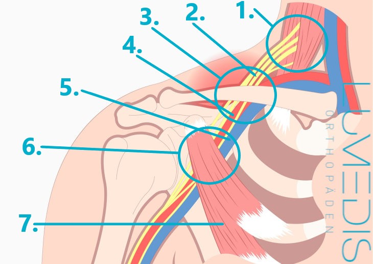 Abbildung der Engstellen bei einem Thoracic-outlet-Syndrom