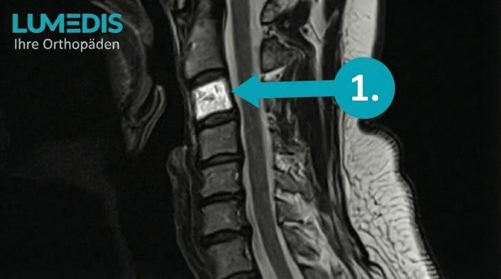 MRT eines atypischen Hämangioms im Wirbelkörper C3 der Halswirbelsäule (HWS) MRT eines atypischen Hämangioms im Wirbelkörper C3 der Halswirbelsäule (HWS)