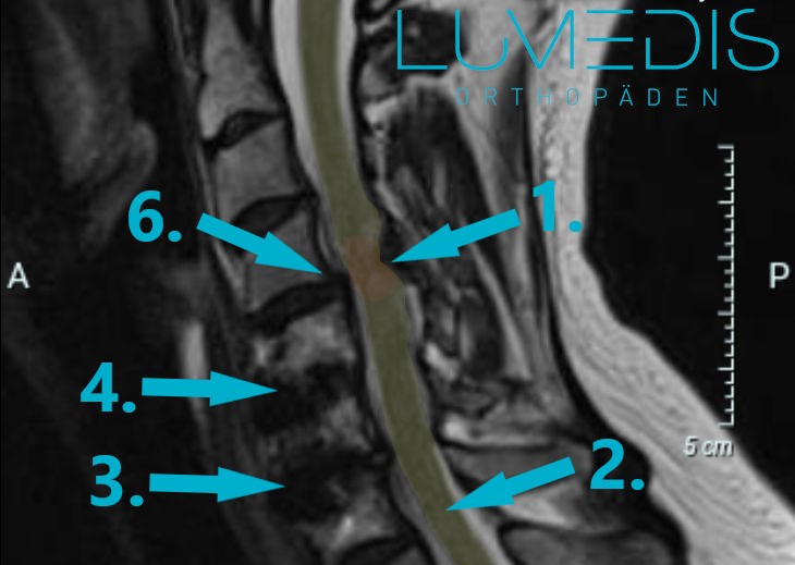 MRT einer Spinalkanalstenose der HWS MRT einer Spinalkanalstenose der HWS