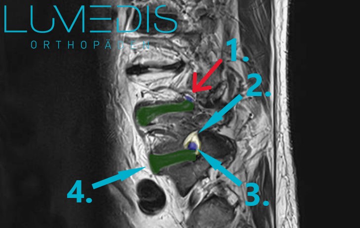 MRT einer Neuroforamenstenose L4/5 rechts MRT einer Neuroforamenstenose L4/5 rechts
