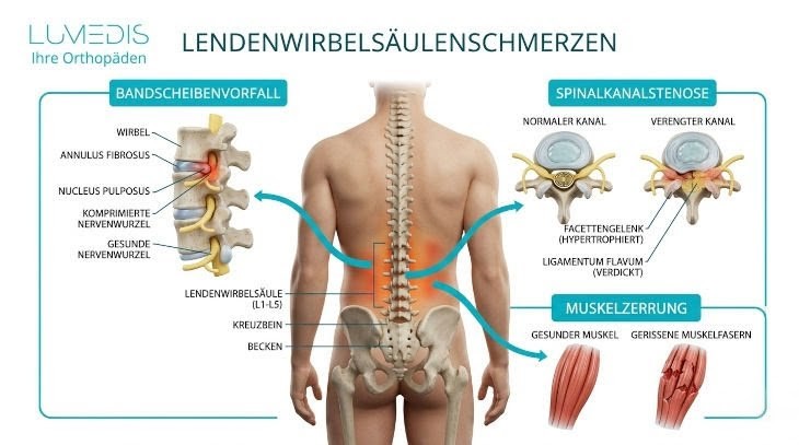 Ursachen lumbaler Rückenschmerzen Ursachen lumbaler Rückenschmerzen