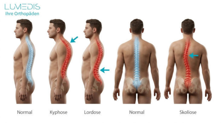 Fehlhaltungen des Rückens Fehlhaltungen des Rückens