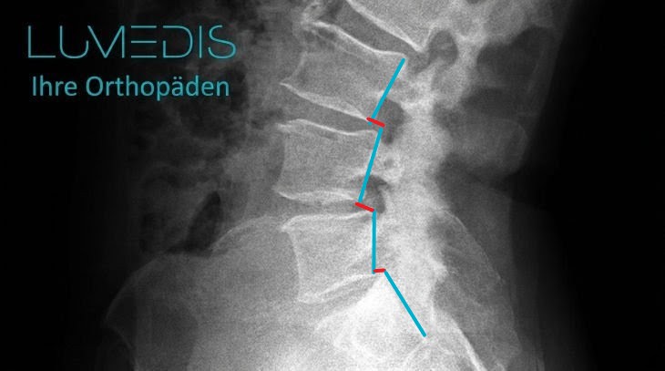 Röntgenbild der LWS mit Wirbelgleiten (Meyerding 1°) Röntgenbild der LWS mit Wirbelgleiten (Meyerding 1°)