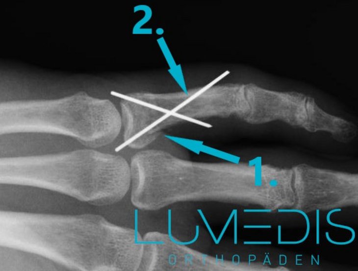 Röntgenbild eines Bruchs des kleinen Fingers der rechten Hand, der mit zwei Kirschner-Drähten fixiert wurde. Röntgenbild eines Bruchs des kleinen Fingers der rechten Hand, der mit zwei Kirschner-Drähten fixiert wurde.