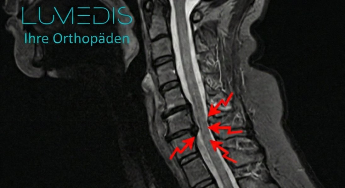 MRT einer Spinalkanalstenose der HWS C5/C6 MRT einer Spinalkanalstenose der HWS C5/C6